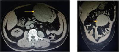 An extremely rare case of malignant jejunal mesenteric inflammatory myofibroblastic tumor in a 61-year-old male patient: A case report and literature review